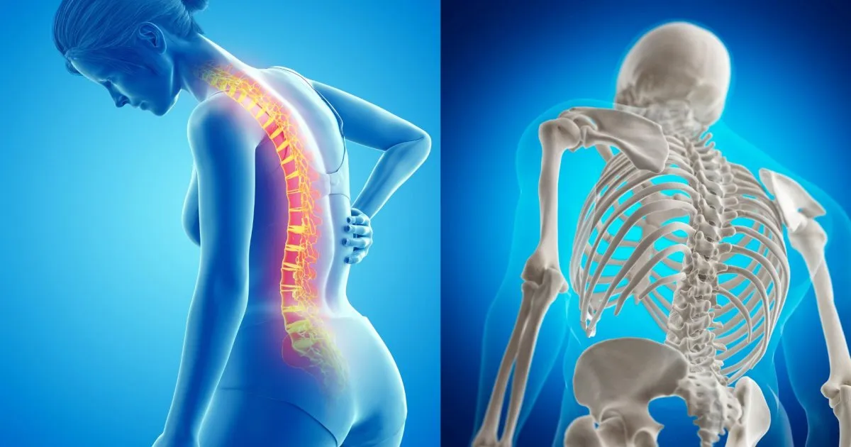 Phụ nữ đau lưng và mô phỏng hệ xương cột sống liên quan đến loãng xương