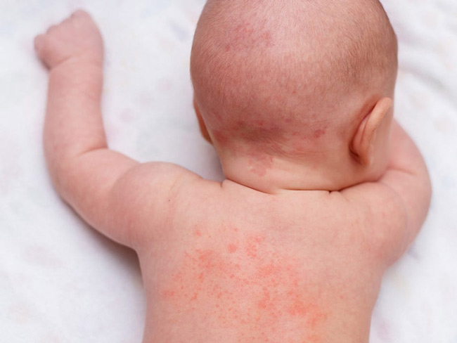 Trên da xuất hiện các nốt mẩn đỏ là dấu hiệu của rôm sẩy