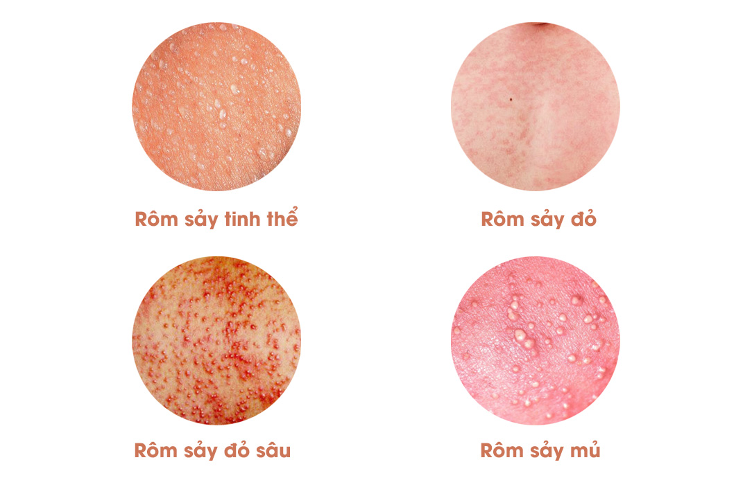 Các loại rôm sảy thường gặp