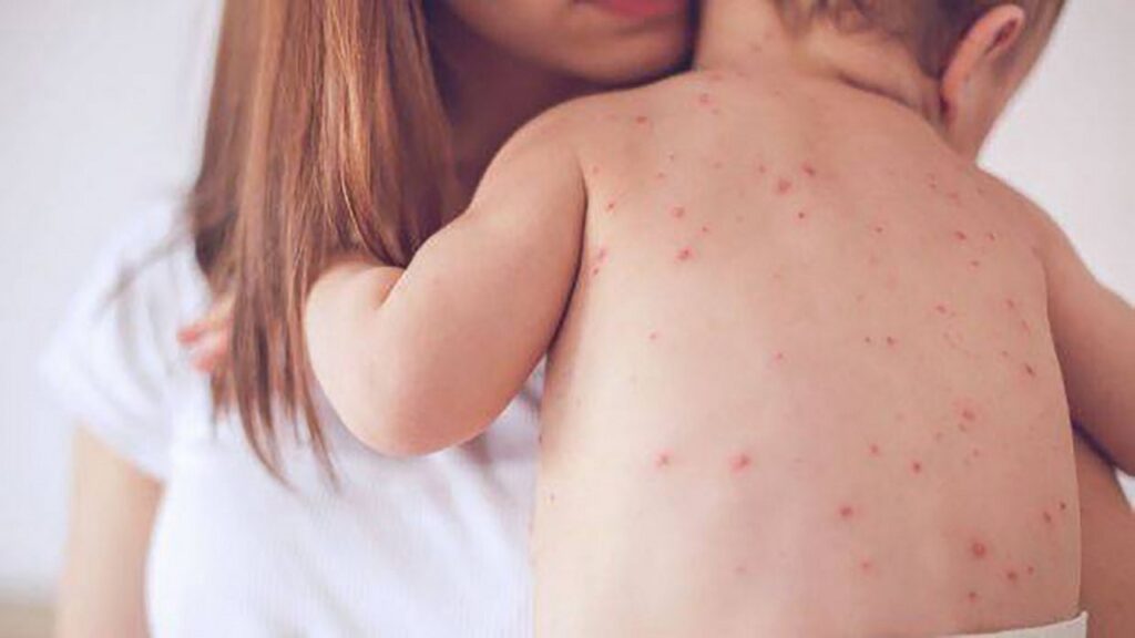 bé bị rôm sảy