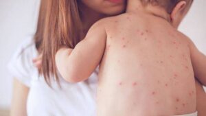 bé bị rôm sảy